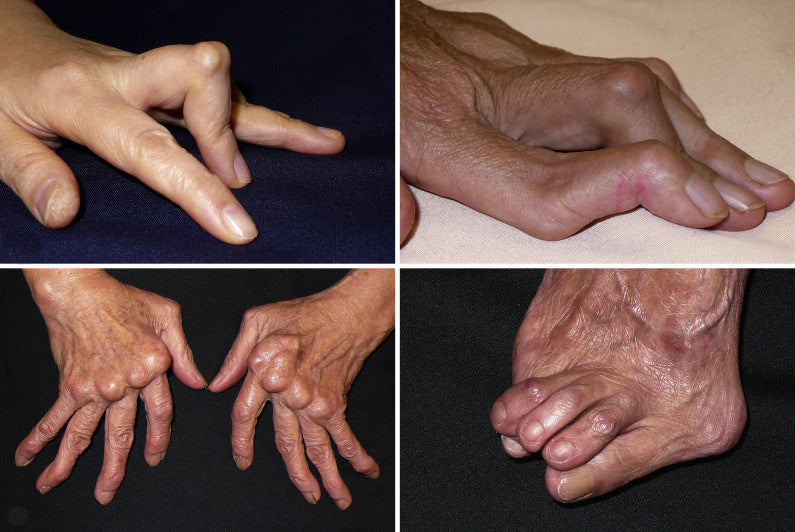 Supporting Individuals with Rheumatoid Arthritis